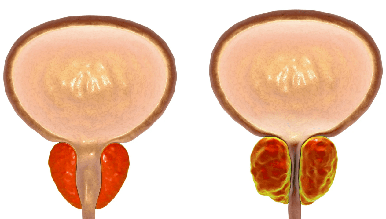 Простатит дегеніміз не