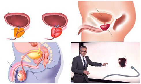 сау және ауру простата
