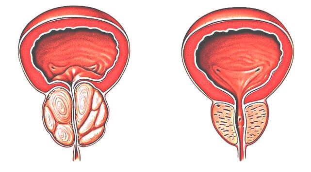 сау және ауру простата